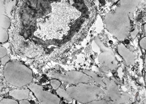 M,35y. | duodenum … lipid malabsorption - susp. hypo-beta-lipoproteinemia M,35y. | duodenum … lipid malabsorption - susp. hypo-beta-lipoproteinemia
